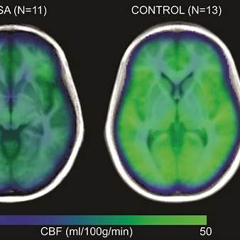 How Sleep Apnea Damages the Brain: What MRI Scans Reveal