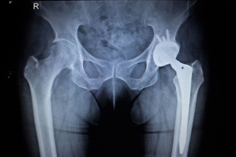 The Connection Between OSA and Joint Replacement Risks