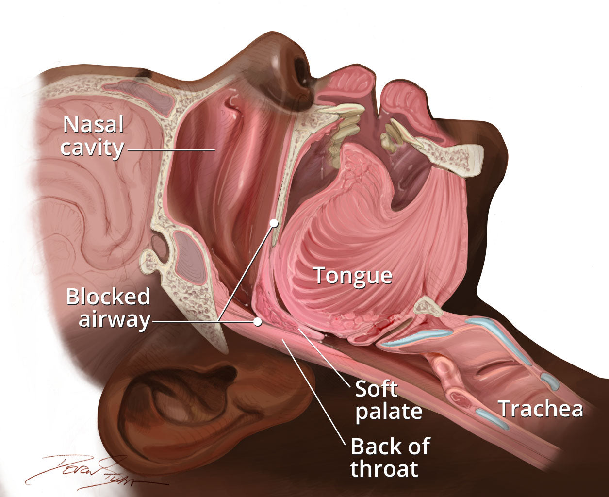 From Causes to Cutting-Edge Solutions: The Evolution of Sleep Apnea Treatment