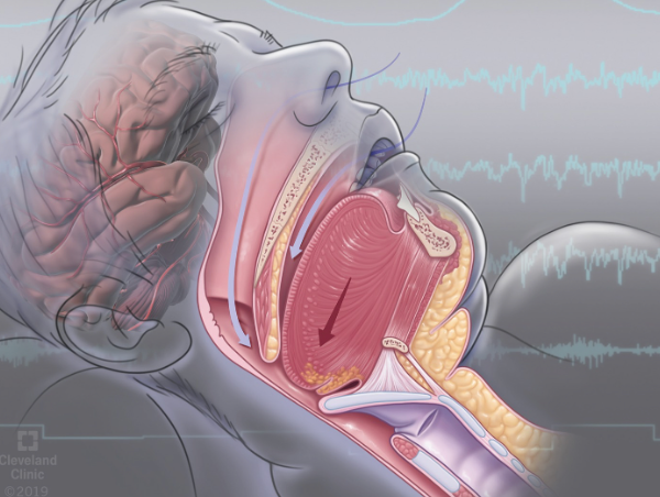 The Efficacy and Long-Term Benefits of Continuous Positive Airway Pressure (CPAP) Therapy for Patients Diagnosed with Obstructive Sleep Apnea: A Comprehensive Review